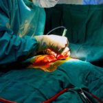 Minimally Invasive Cardiac Surgery